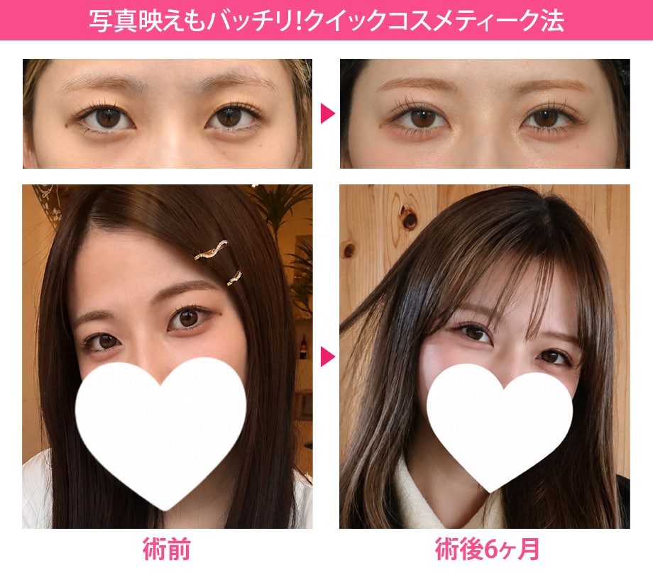 施術解説小カテ