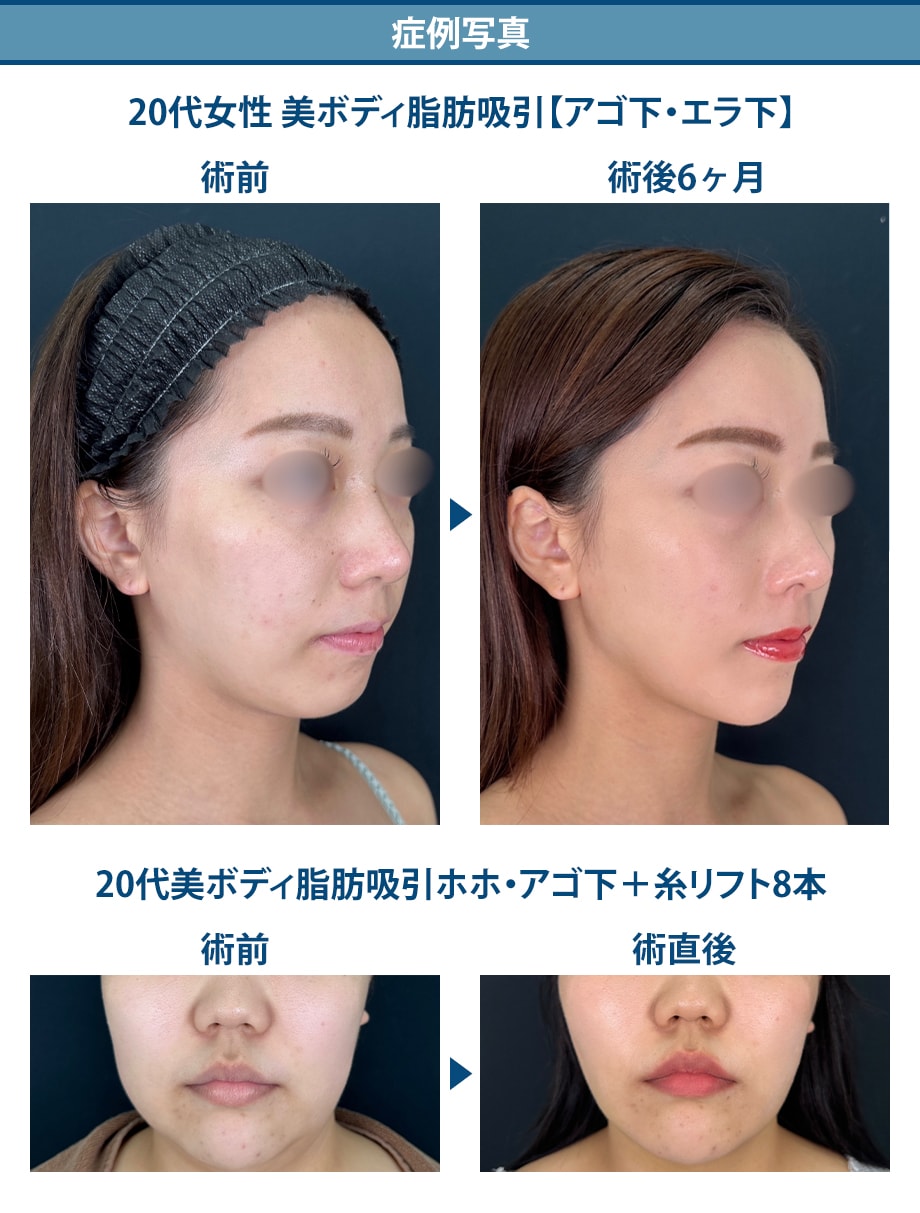 美ボディ脂肪吸引症例写真