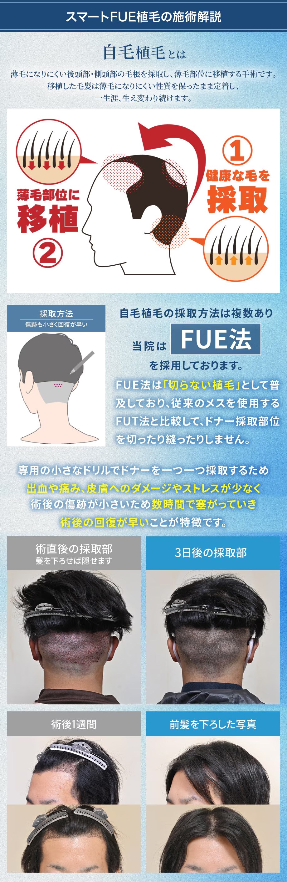 スマートFUE植毛】最先端の切らない植毛で髪のお悩み解決します！