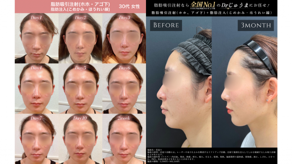 脂肪吸引注射・脂肪注入・糸リフトのダウンタイム経過写真