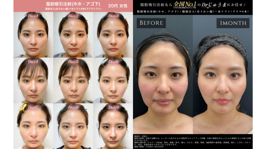 脂肪吸引注射・脂肪注入・糸リフトのダウンタイム経過写真