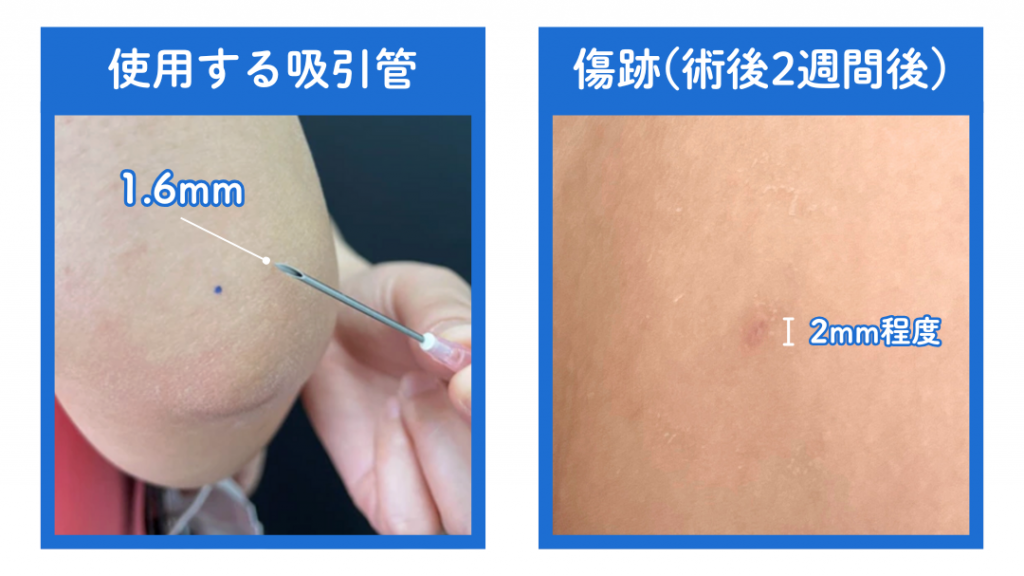 脂肪吸引注射で使用する針・脂肪吸引で使用する針