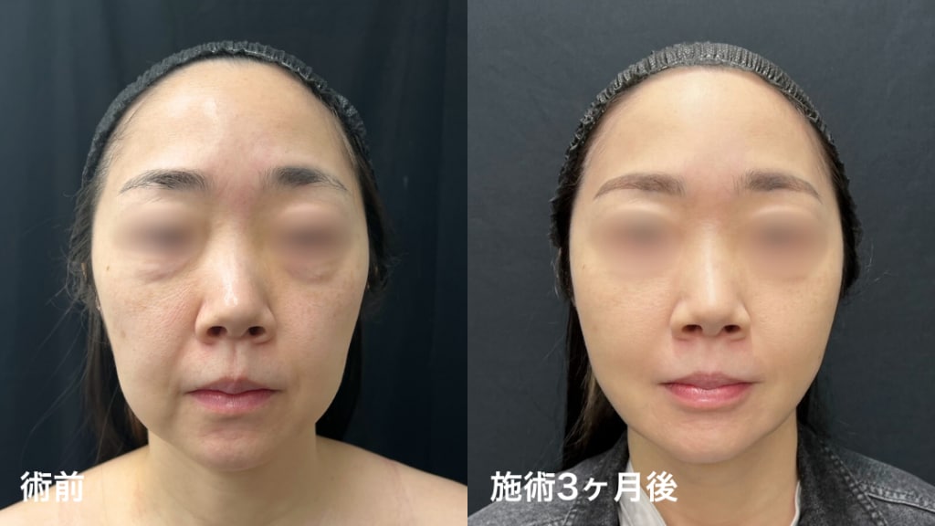 糸リフト（シークレットリフト10本）＋脂肪吸引注射（ホホ・ジョールファット） 40代症例写真