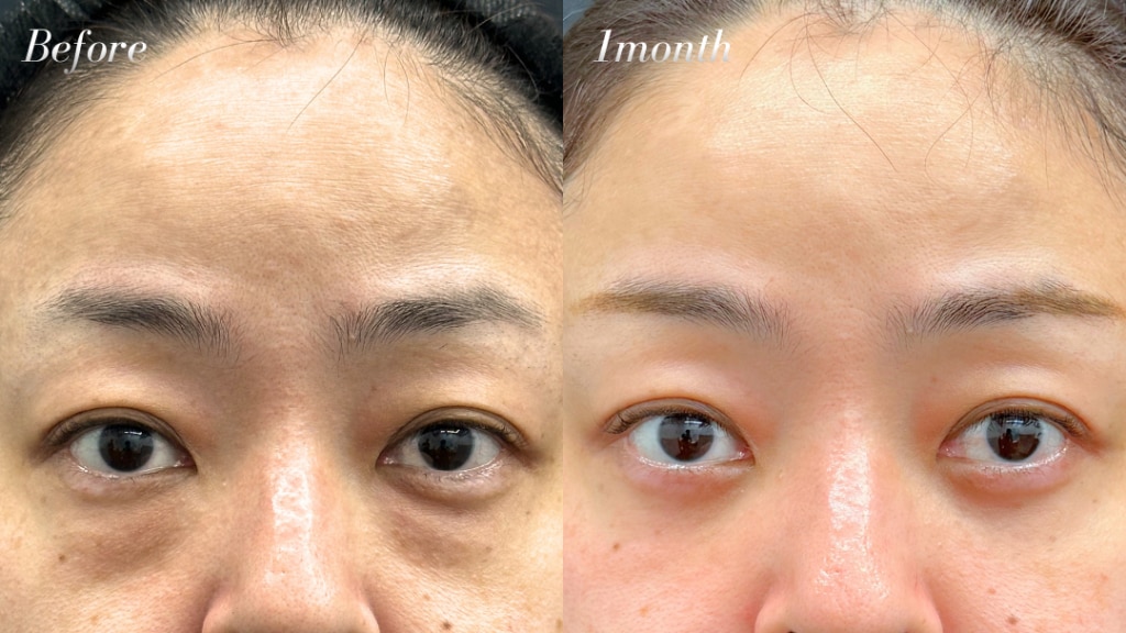 【濱田純医師執刀】目の下の切らないクマ・たるみ取り＋目の下〜ゴルゴライン脂肪注入（ナチュラル脂肪注射） 40代女性