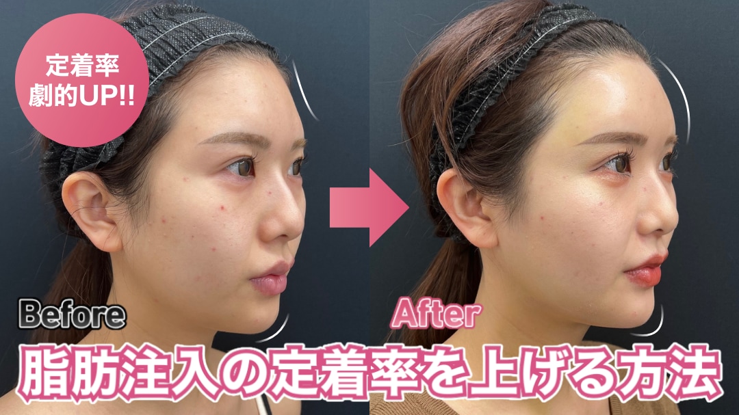 脂肪注入の定着率を上げる方法