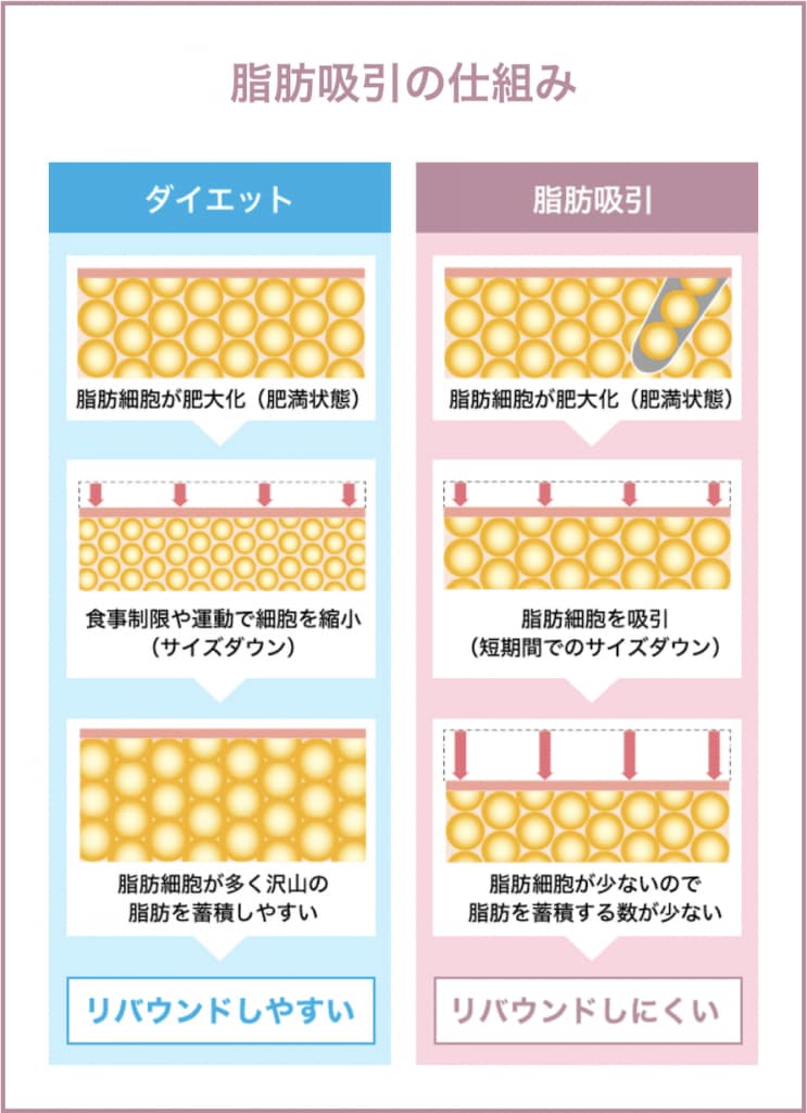 脂肪吸引の仕組み