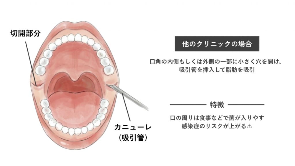 メーラー・ナゾラビアル 吸引管挿入イメージ(他院)