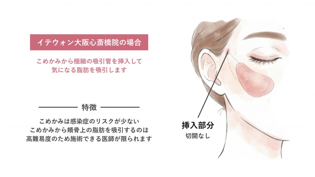 メーラー・ナゾラビアル 吸引管挿入イメージ(他院)