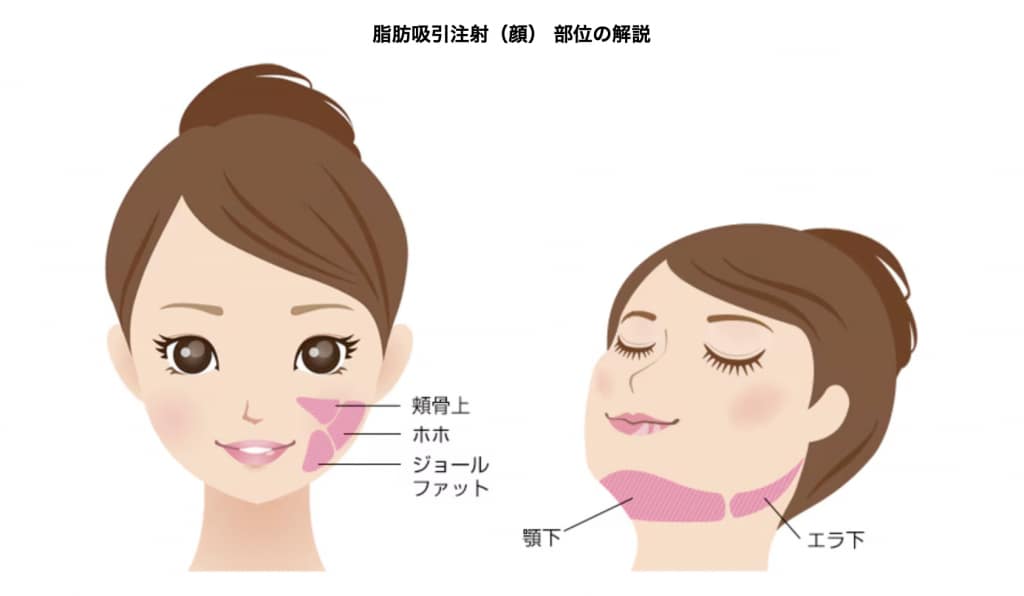 顔の脂肪吸引注射　対象部位
