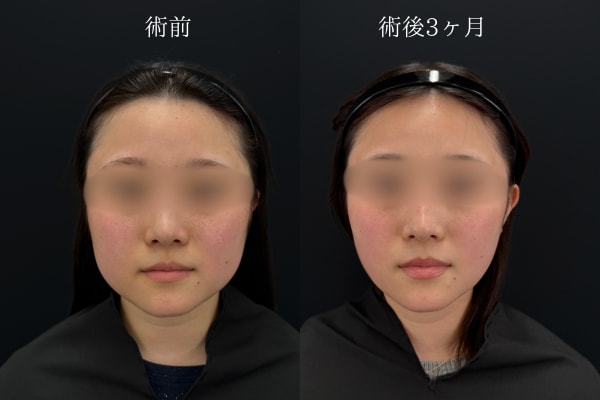 脂肪吸引（ホホ・アゴ下・ジョールファット）