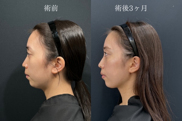 脂肪吸引注射（アゴ下）