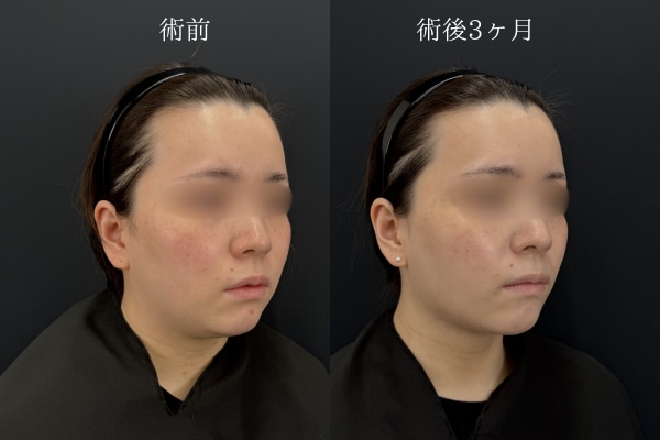 脂肪吸引（ホホ・アゴ下・ジョールファット）