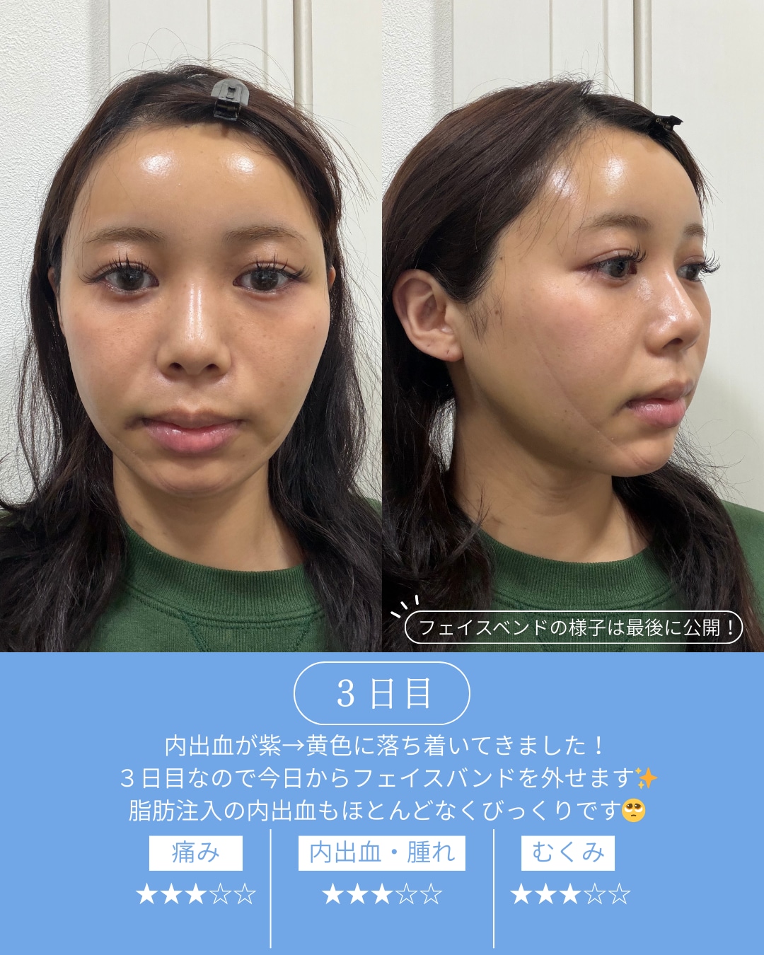 ダウンタイム3日目