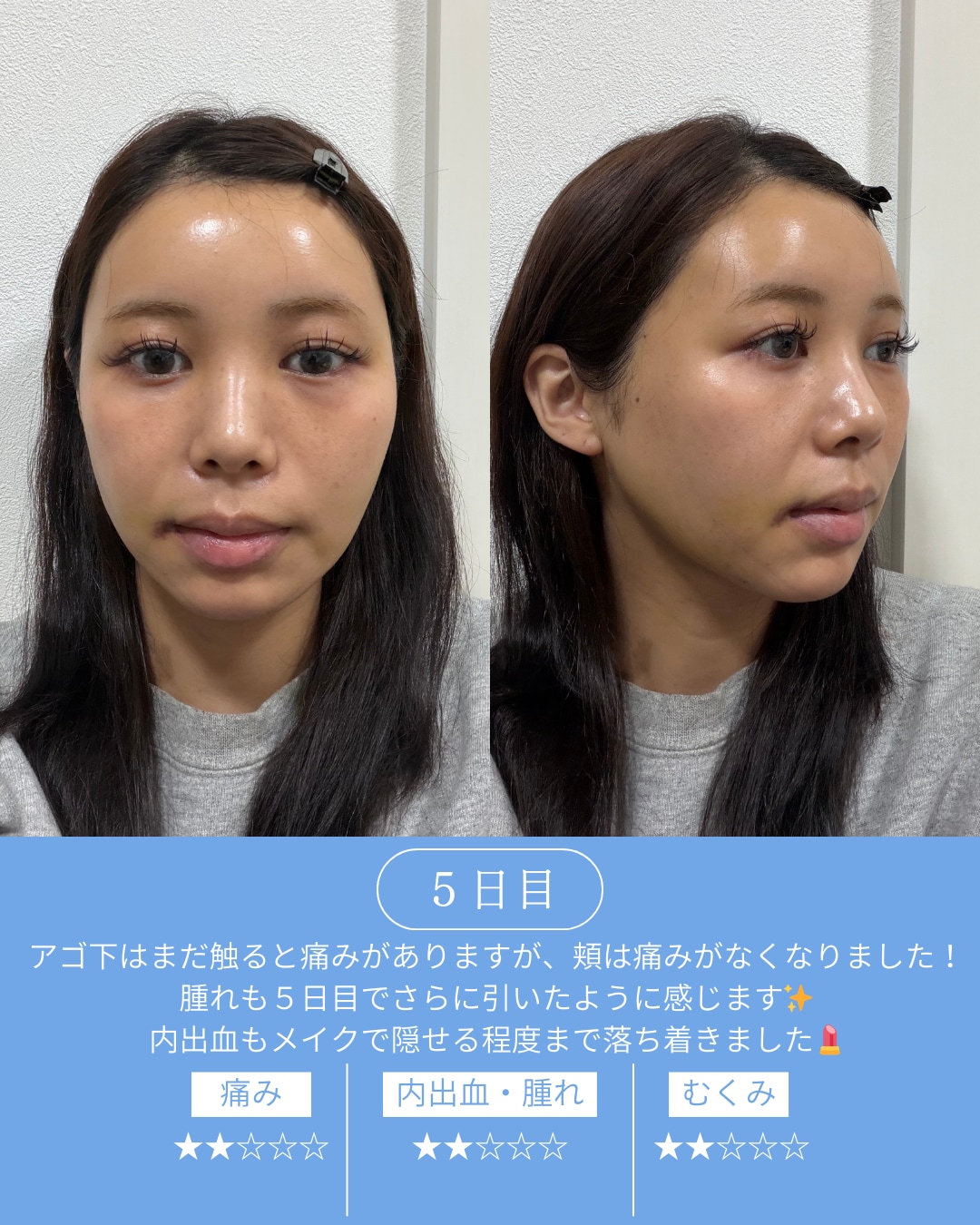 ダウンタイム5日目