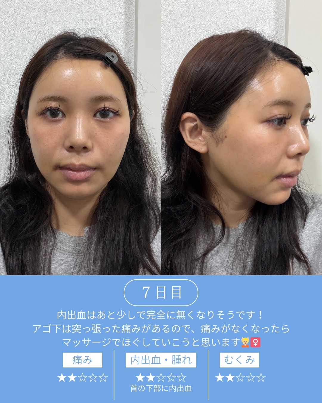 ダウンタイム7日目