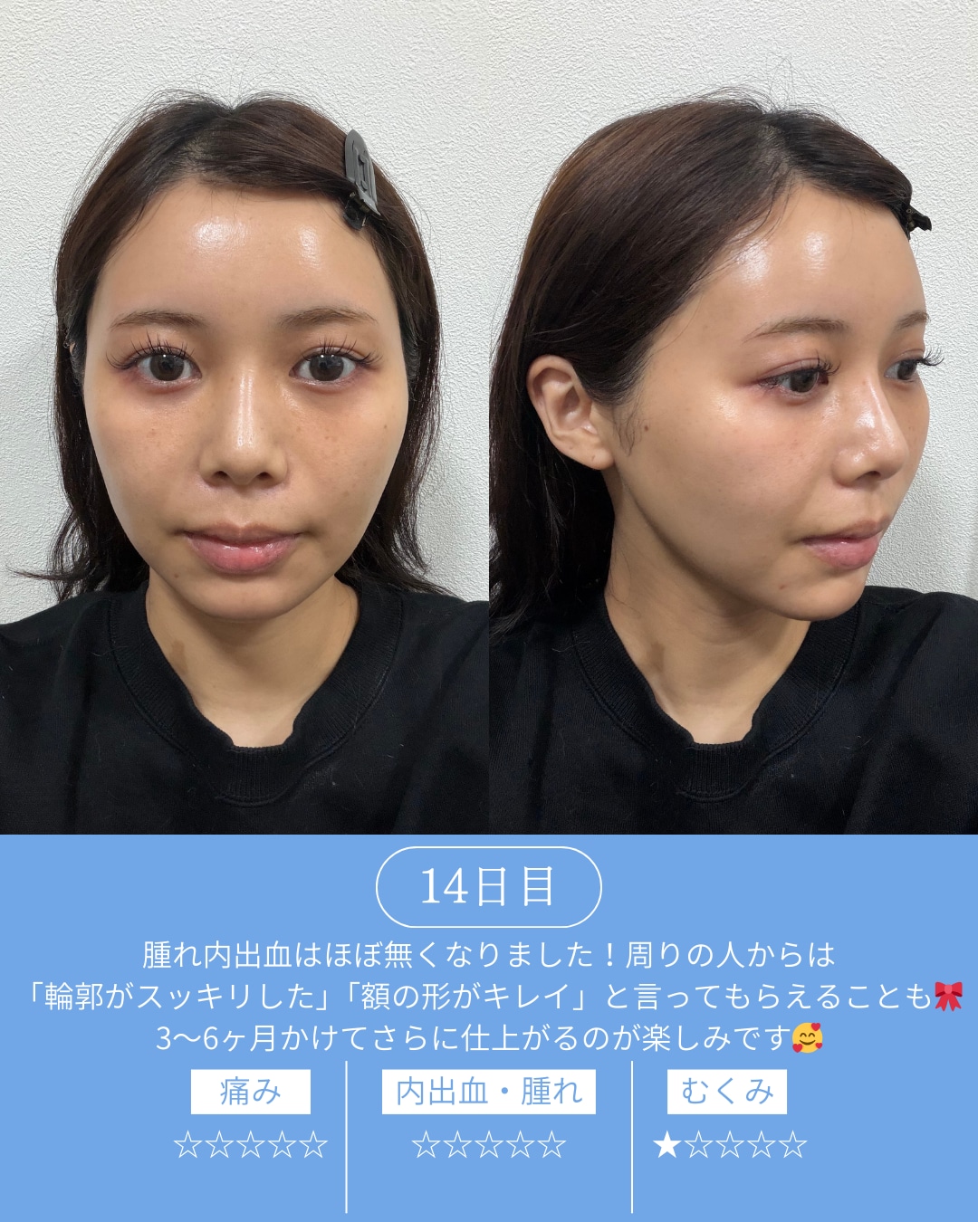 ダウンタイム14日目