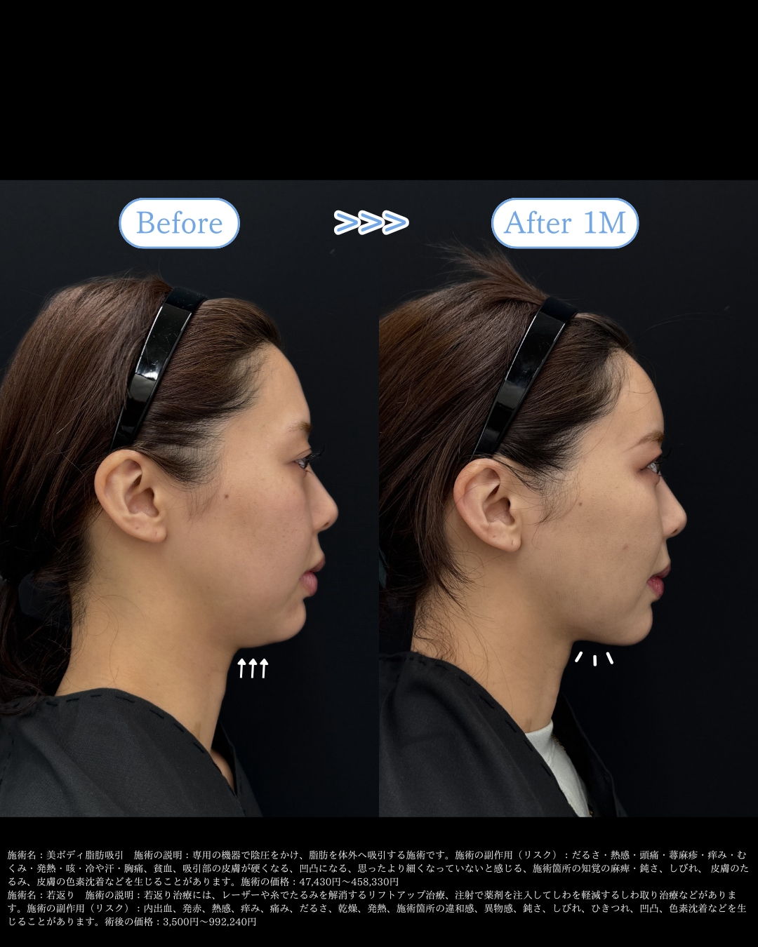 1ヶ月Before→After