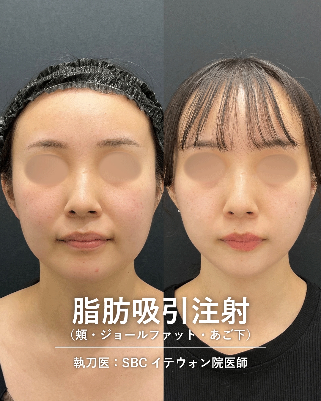 脂肪吸引注射1
