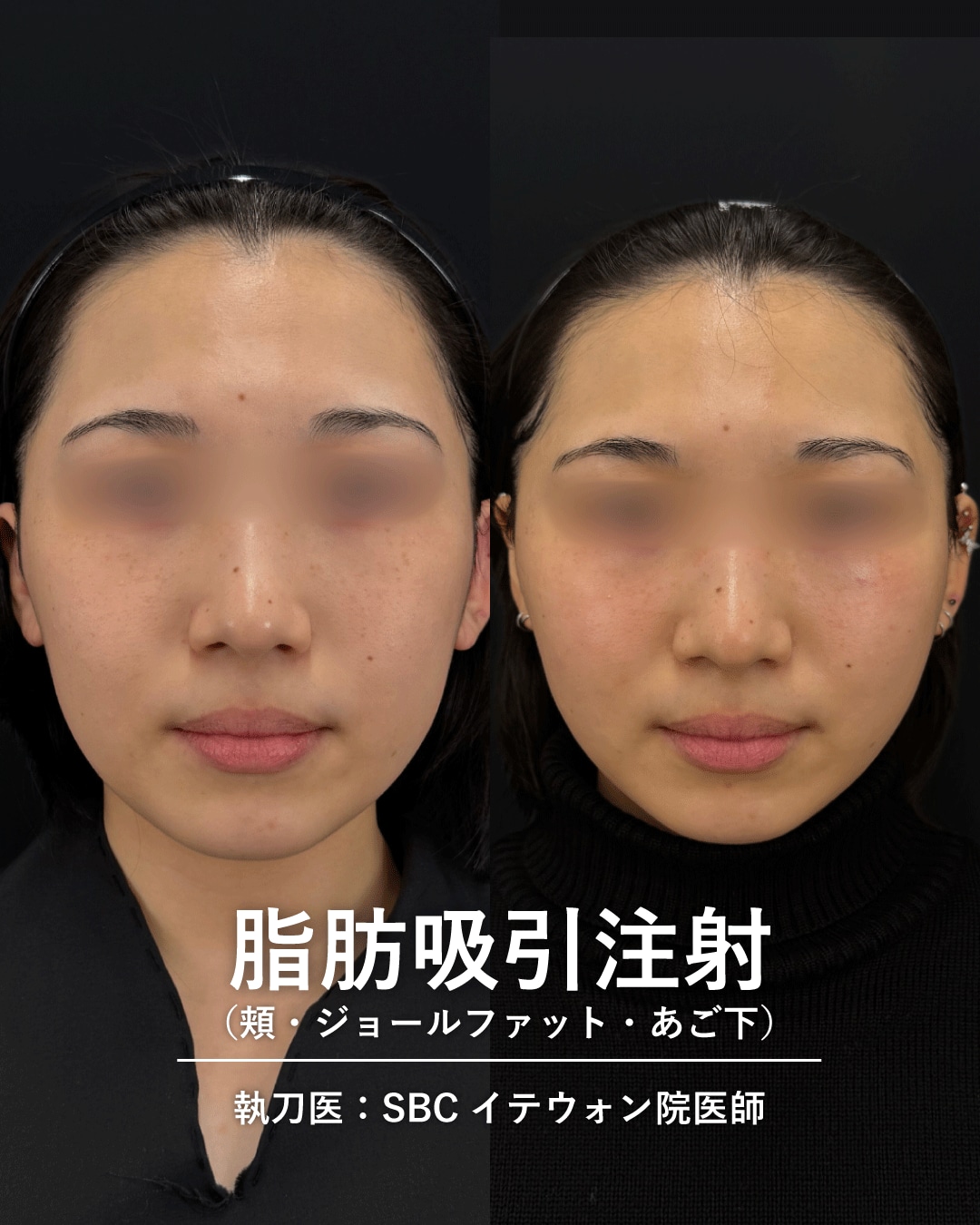 脂肪吸引注射2