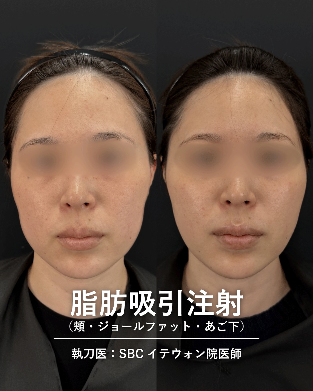脂肪吸引注射3