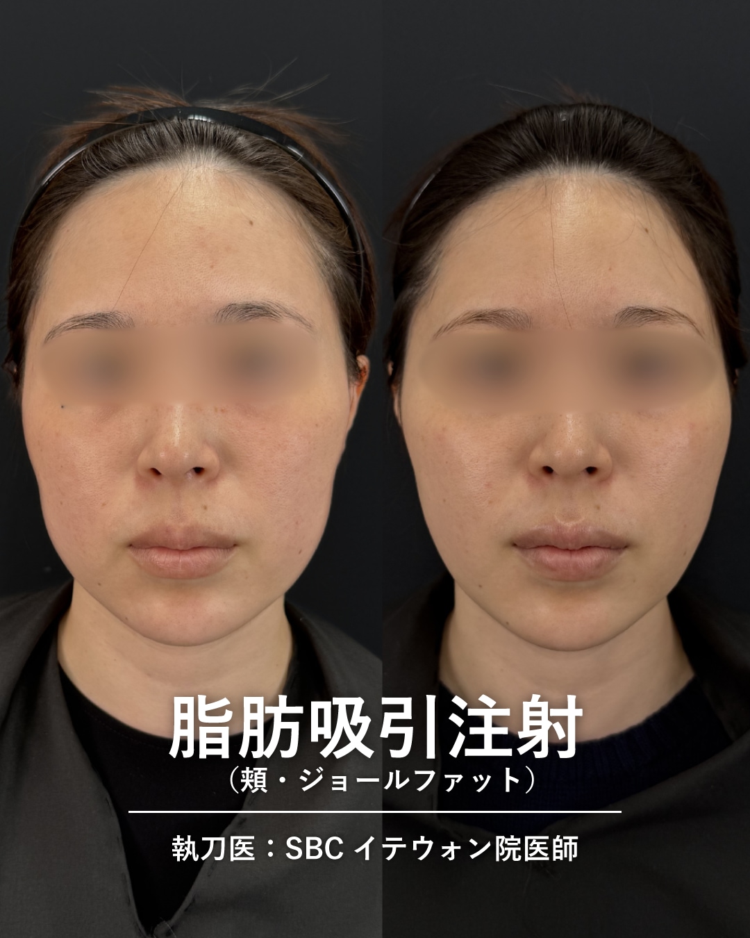 脂肪吸引注射4