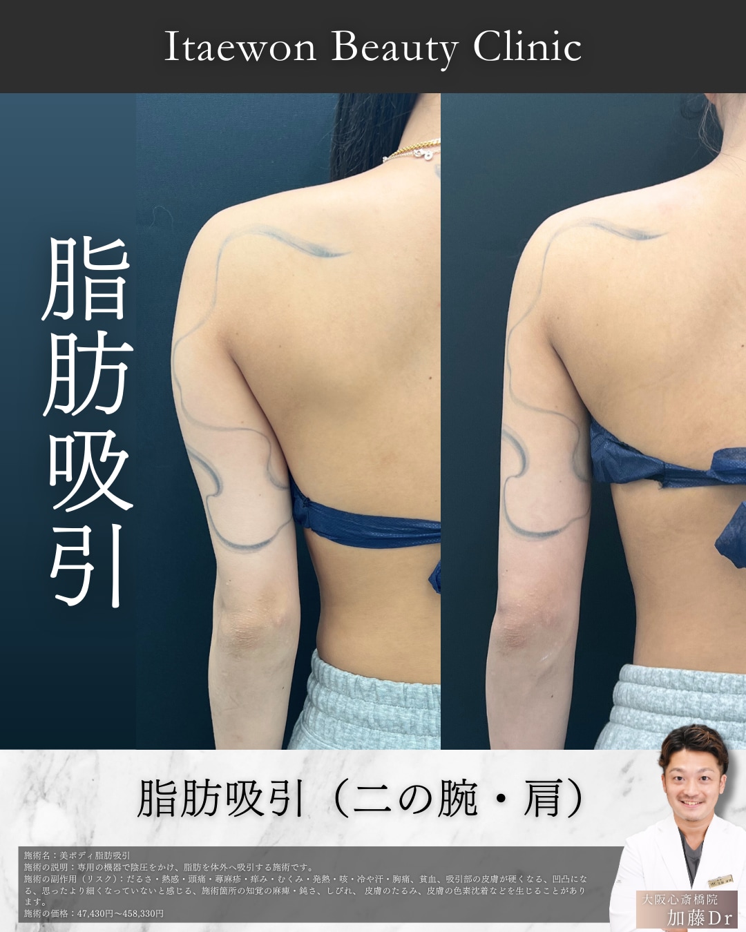 二の腕4