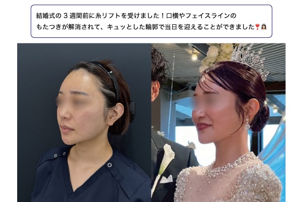 挙式から逆算する糸リフトのスケジュール図