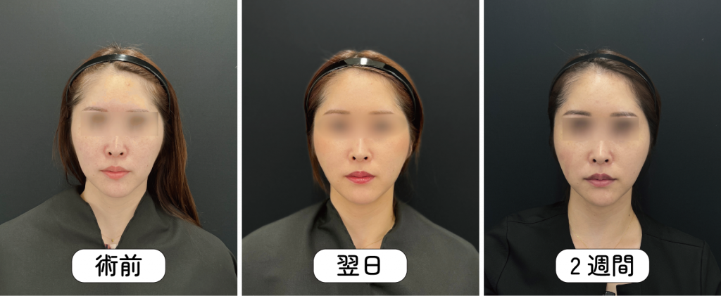 糸リフトのダウンタイム経過
