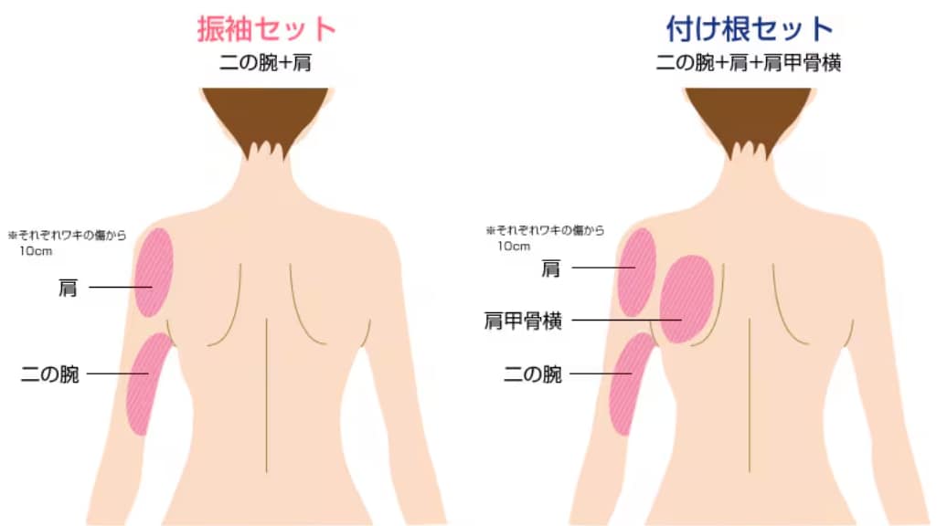 二の腕脂肪吸引注射 対象部位