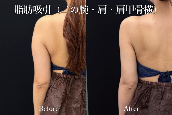 二の腕脂肪吸引の症例