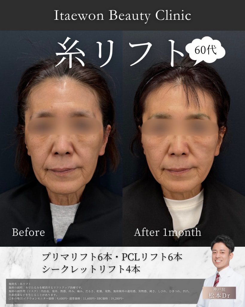 糸リフト症例3