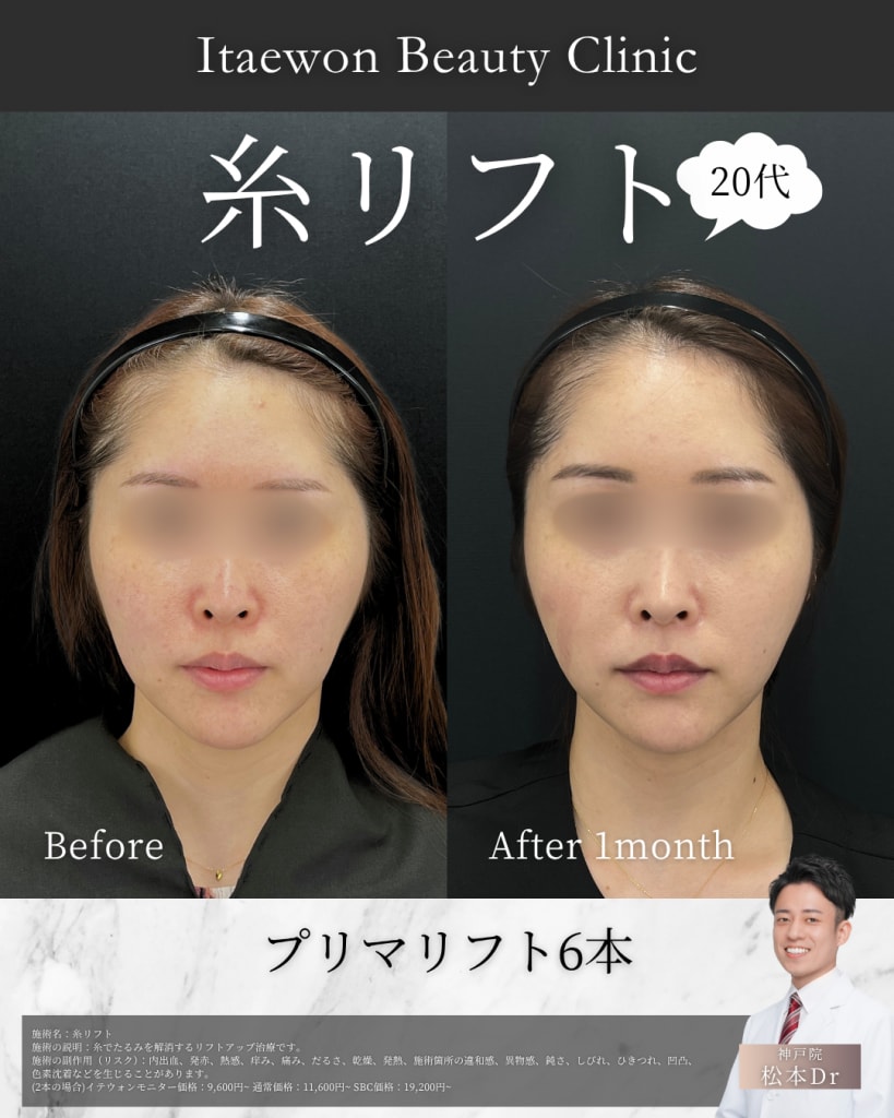 糸リフト症例