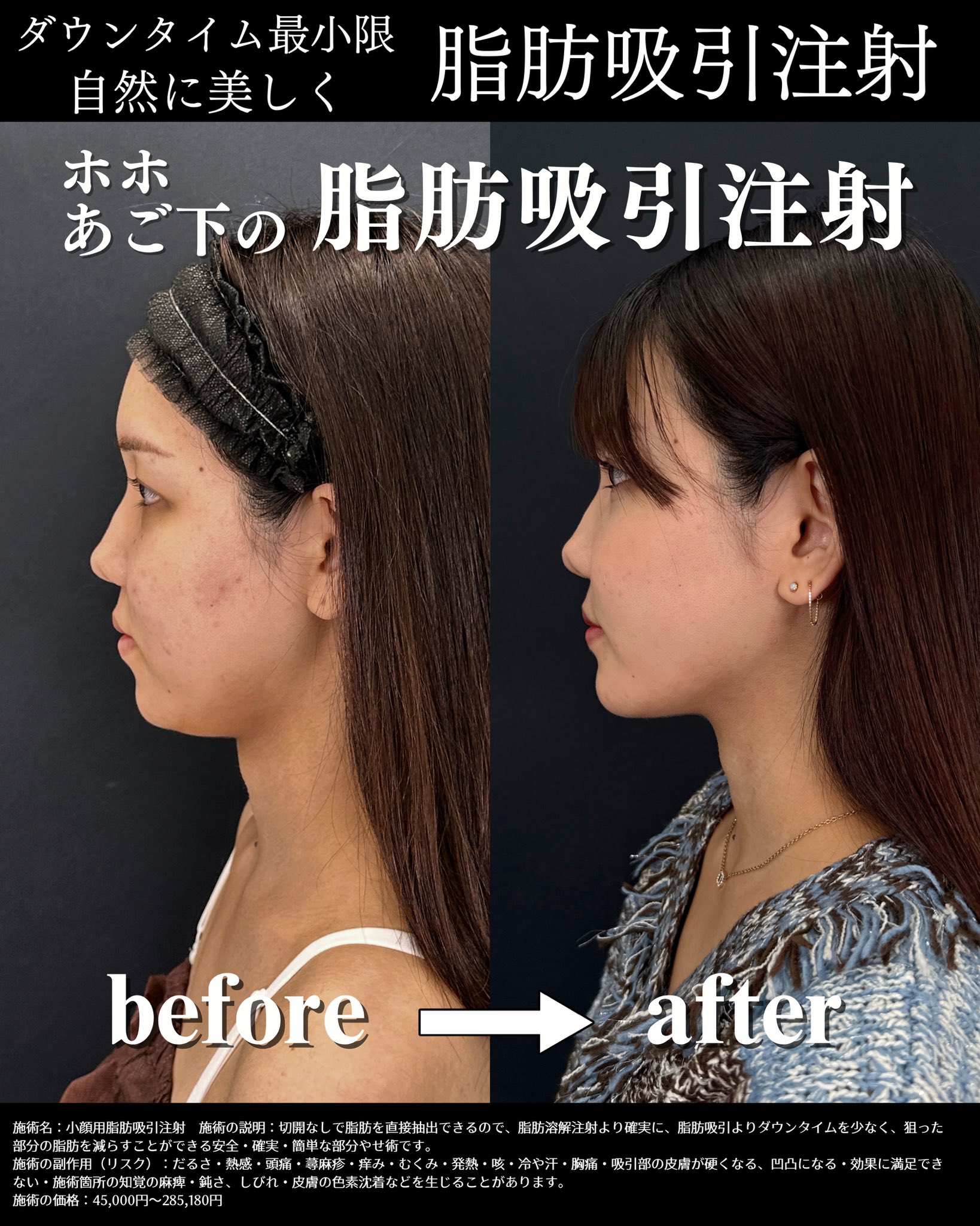 脂肪吸引注射症例写真