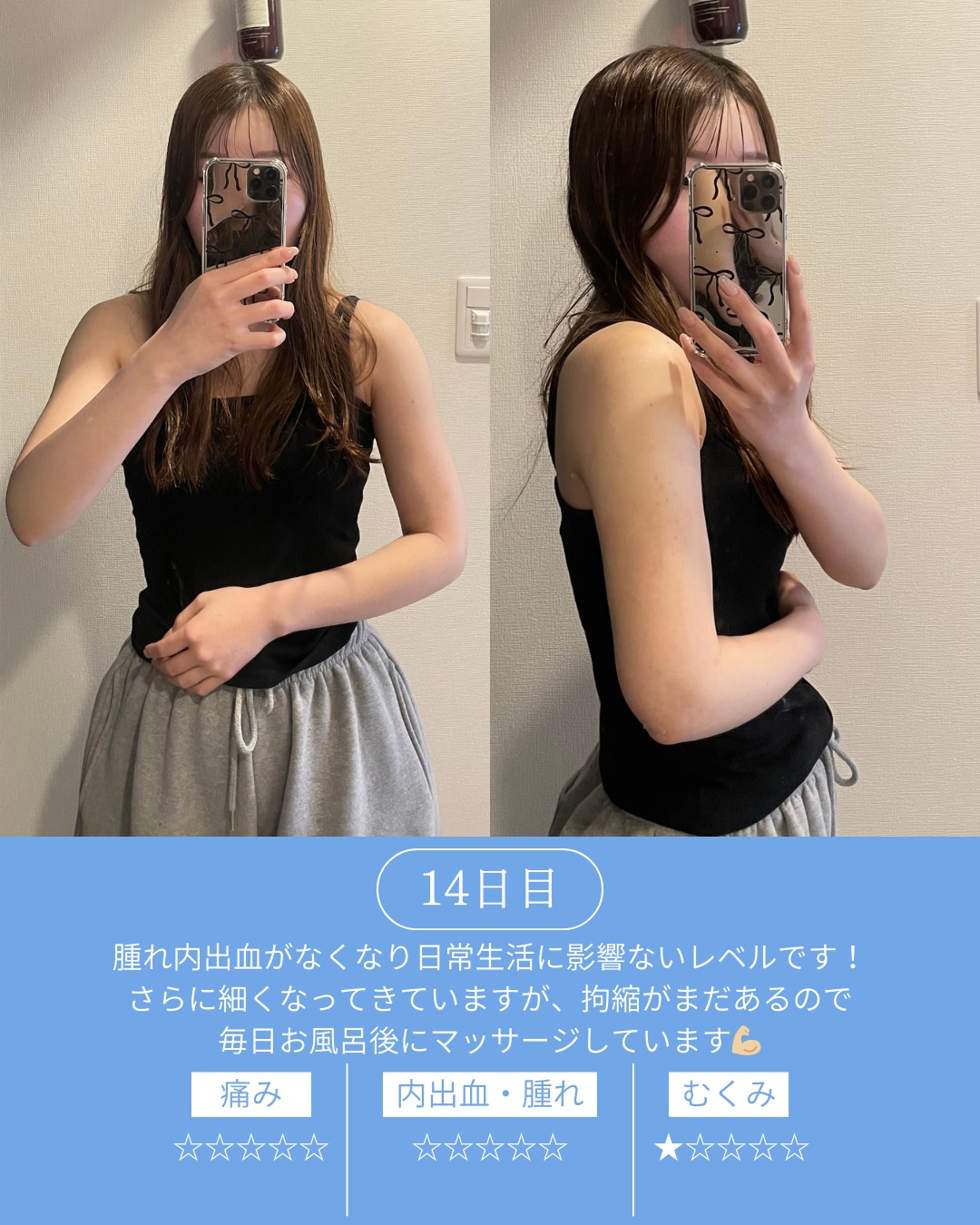 術後14日目