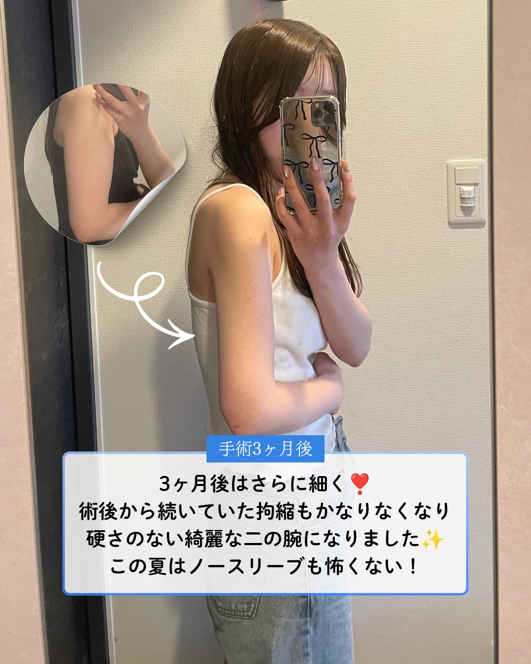 術後3ヶ月
