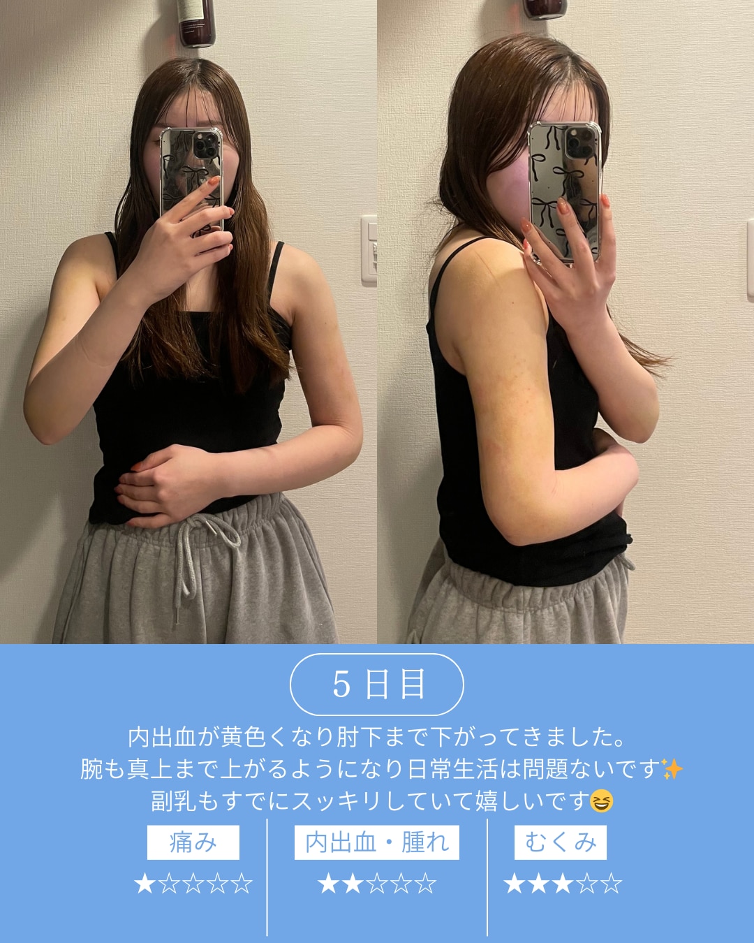 術後5日目