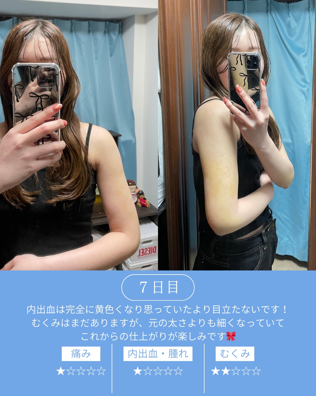 術後7日目