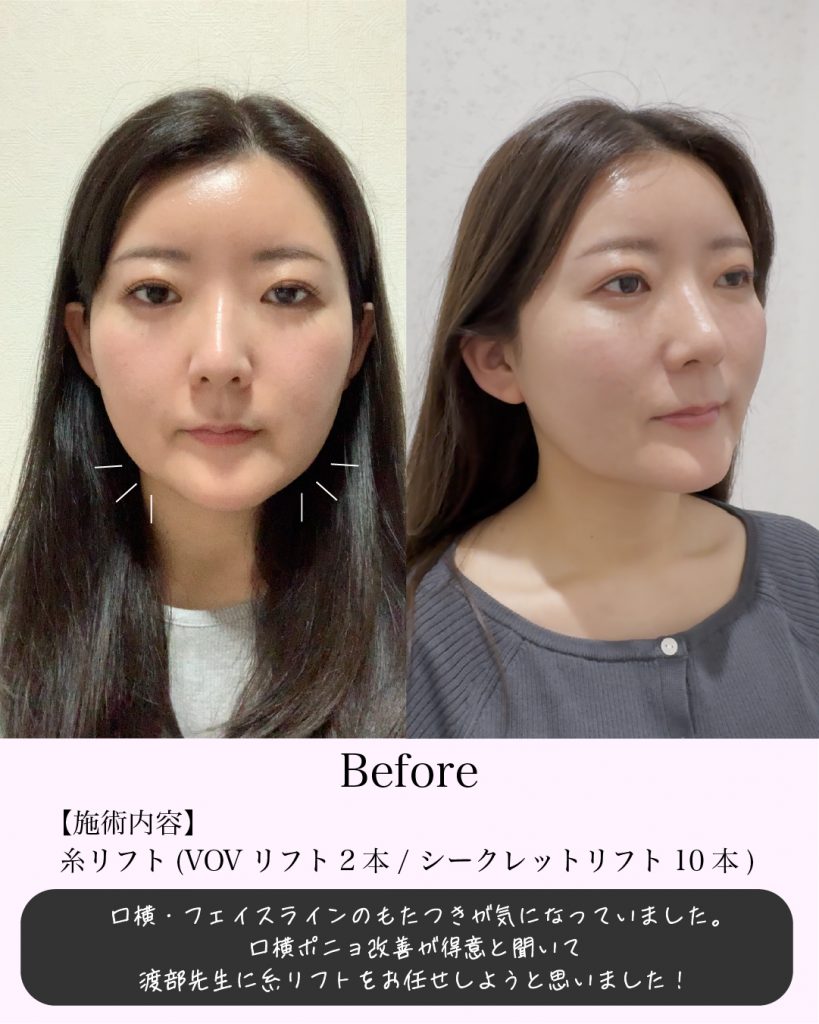 症例写真1