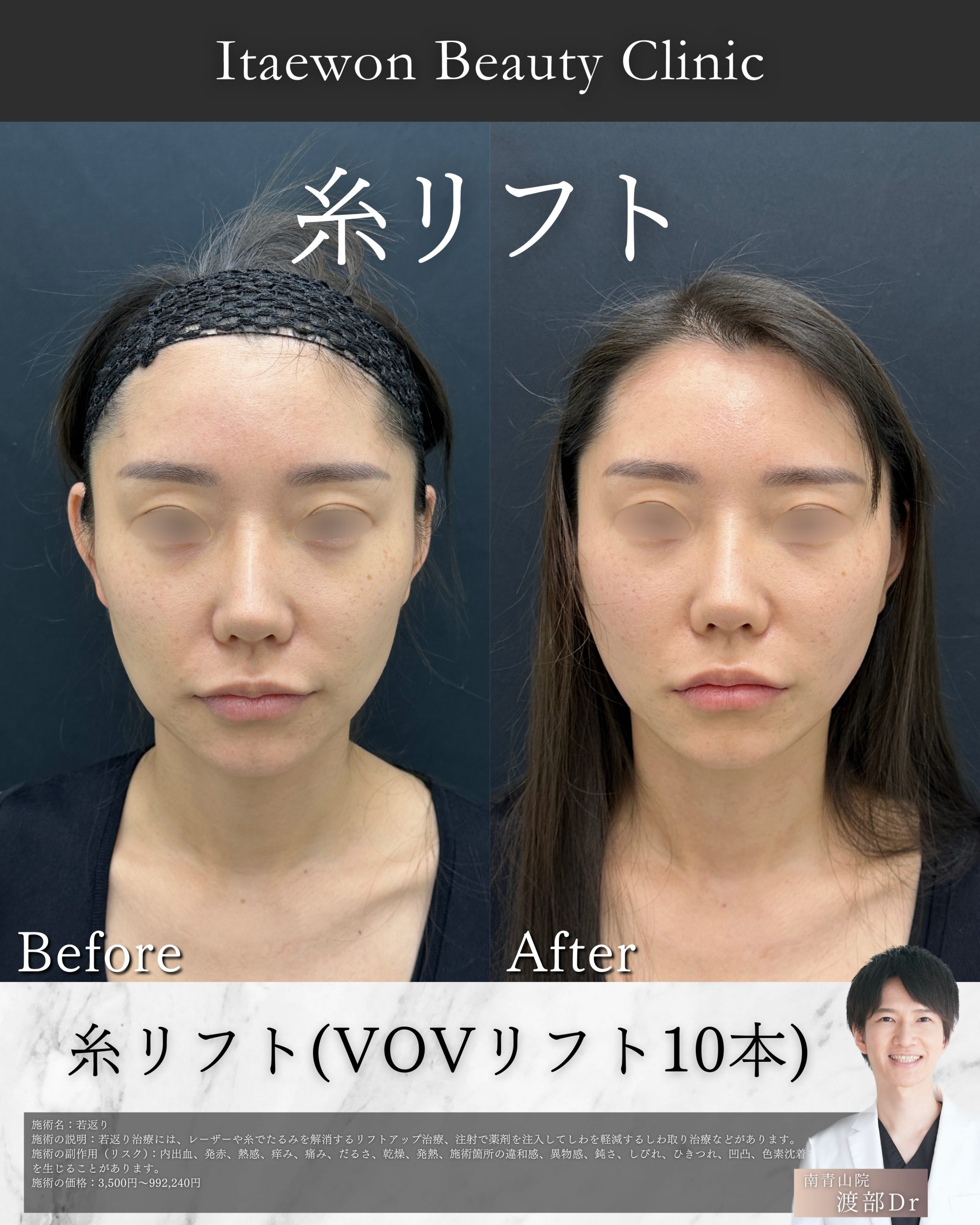 糸リフト症例写真