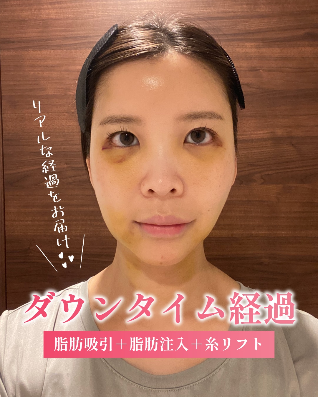 ダウンタイム経過