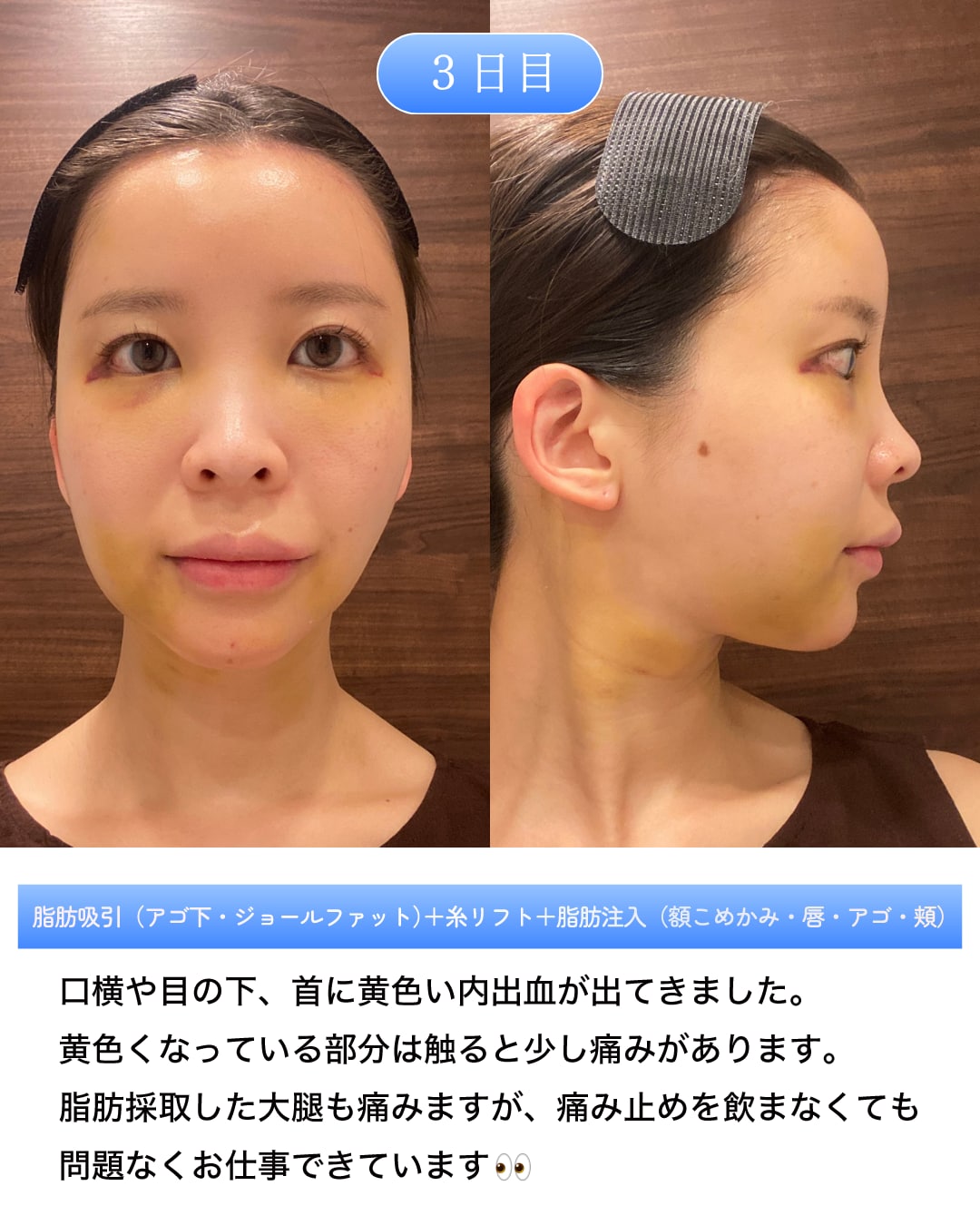 術後3日目