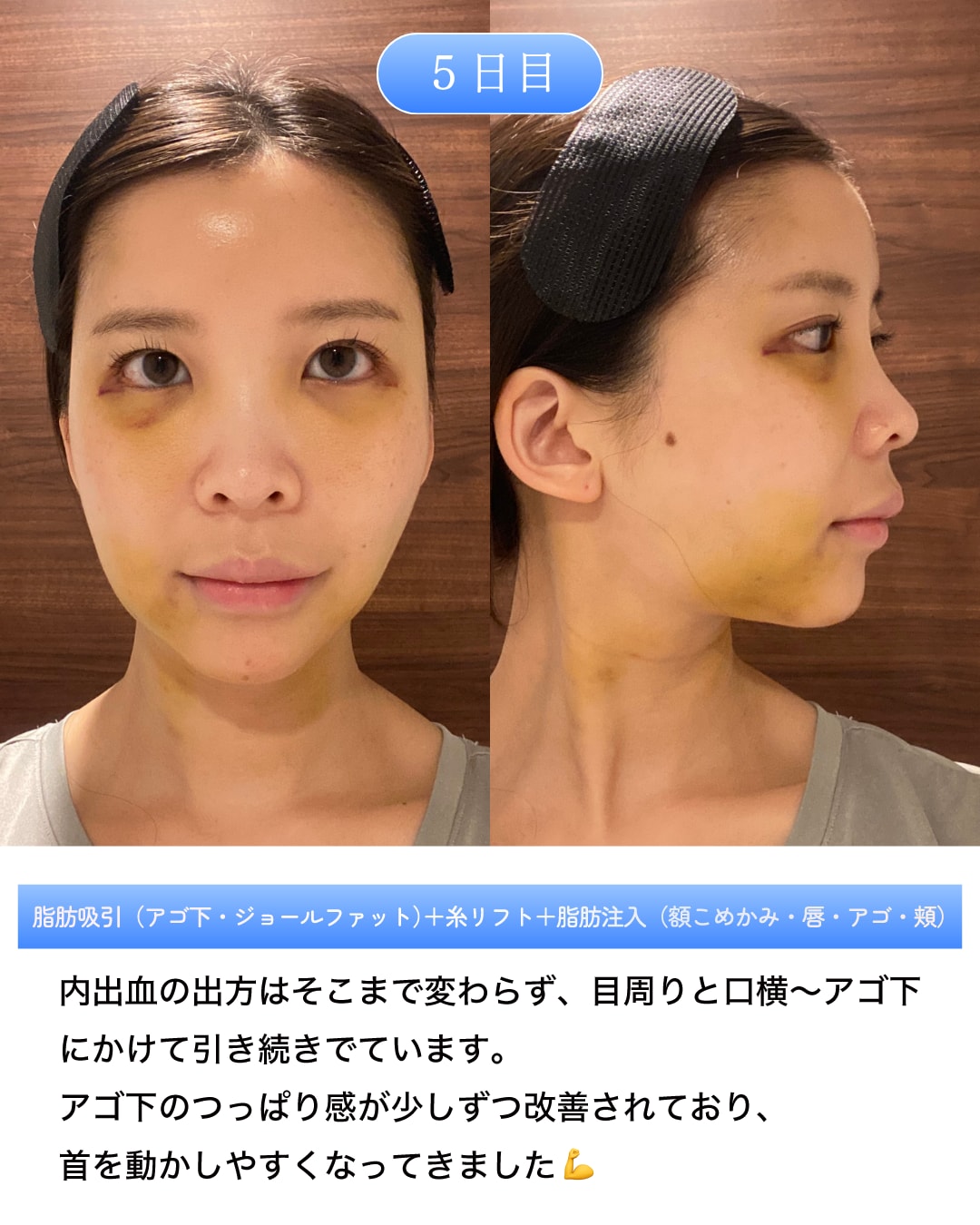 術後5日目