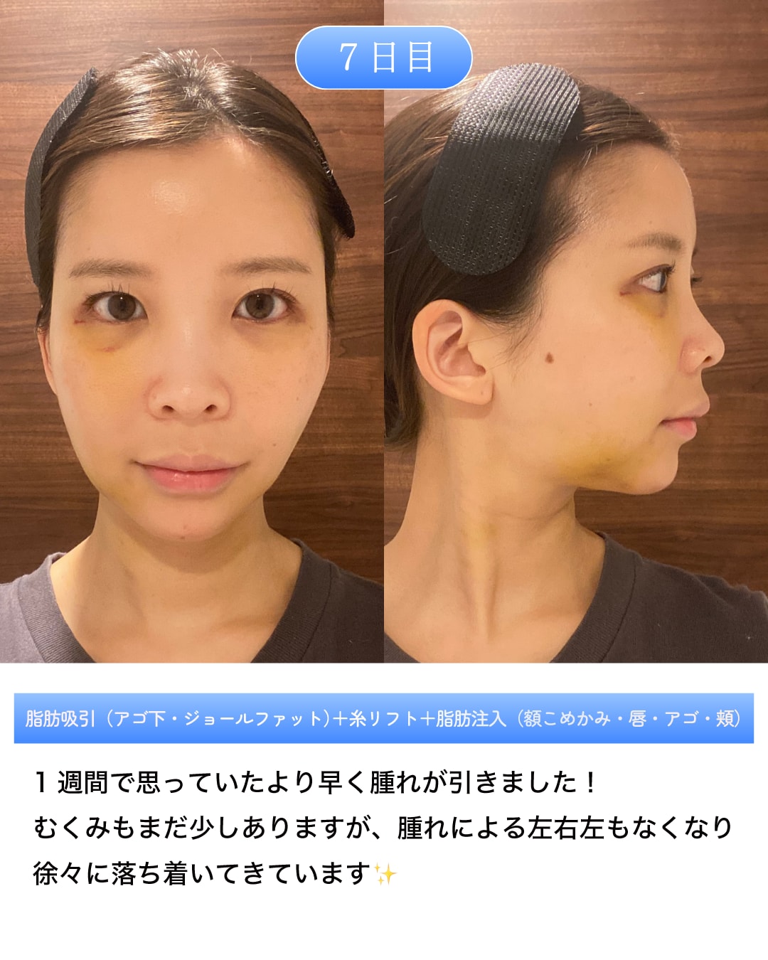 術後7日目