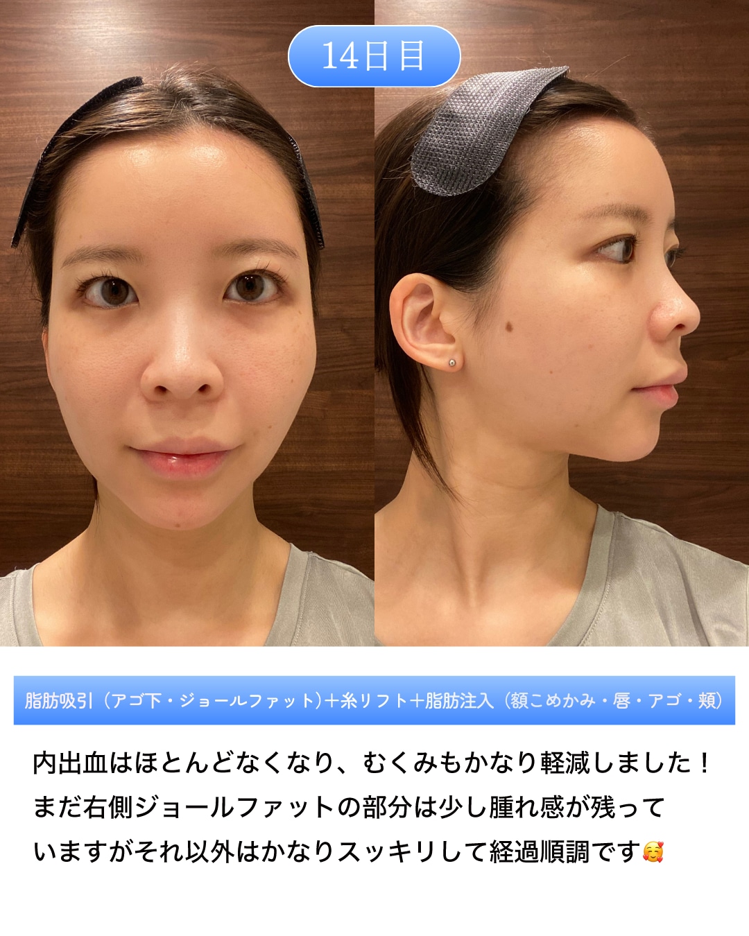 術後14日目