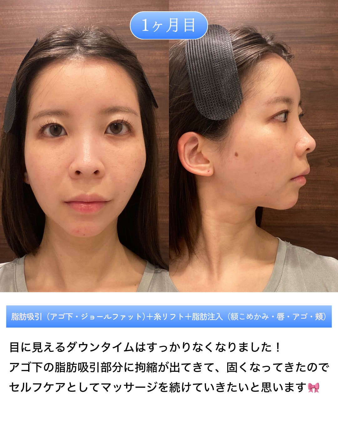 術後1ヶ月