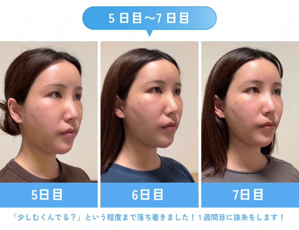 5日目〜7日目