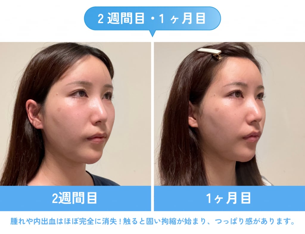 2週間目・1ヶ月目