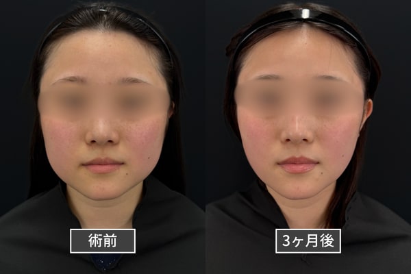 顔の脂肪吸引