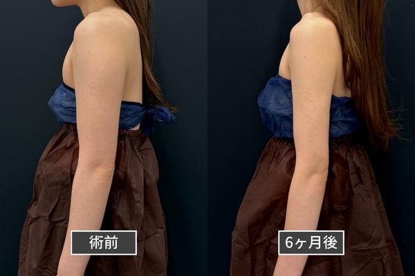 二の腕脂肪吸引