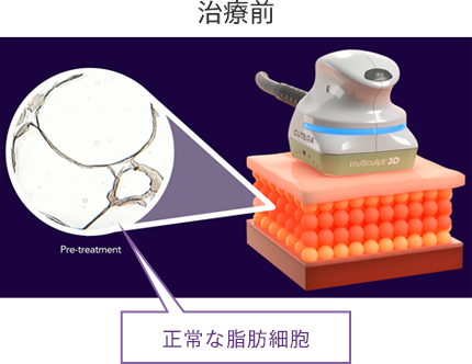 実際の脂肪細胞の変化の様子 治療前